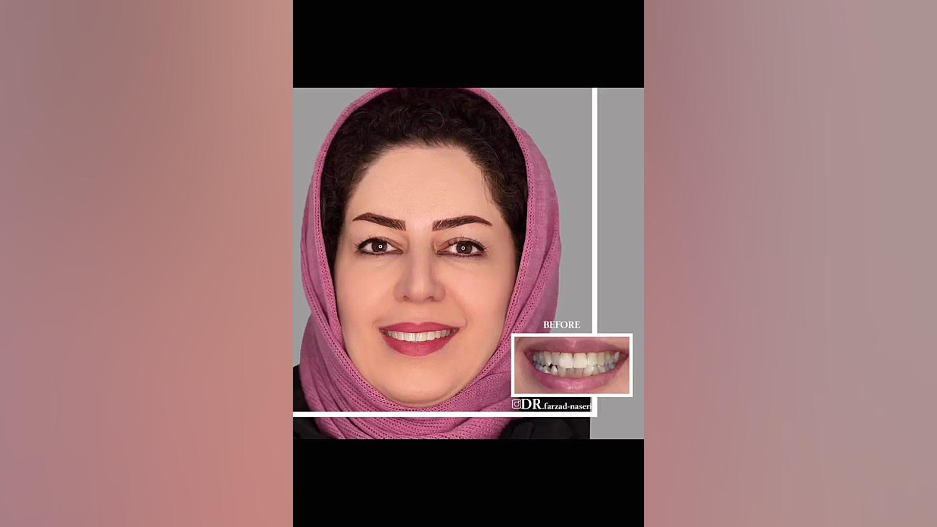 ارتودنسی بدون کشیدن دندان و در مدت ۱۴ ماه دکتر فرزاد ناصری متخصص ارتودنسی در اصفهان