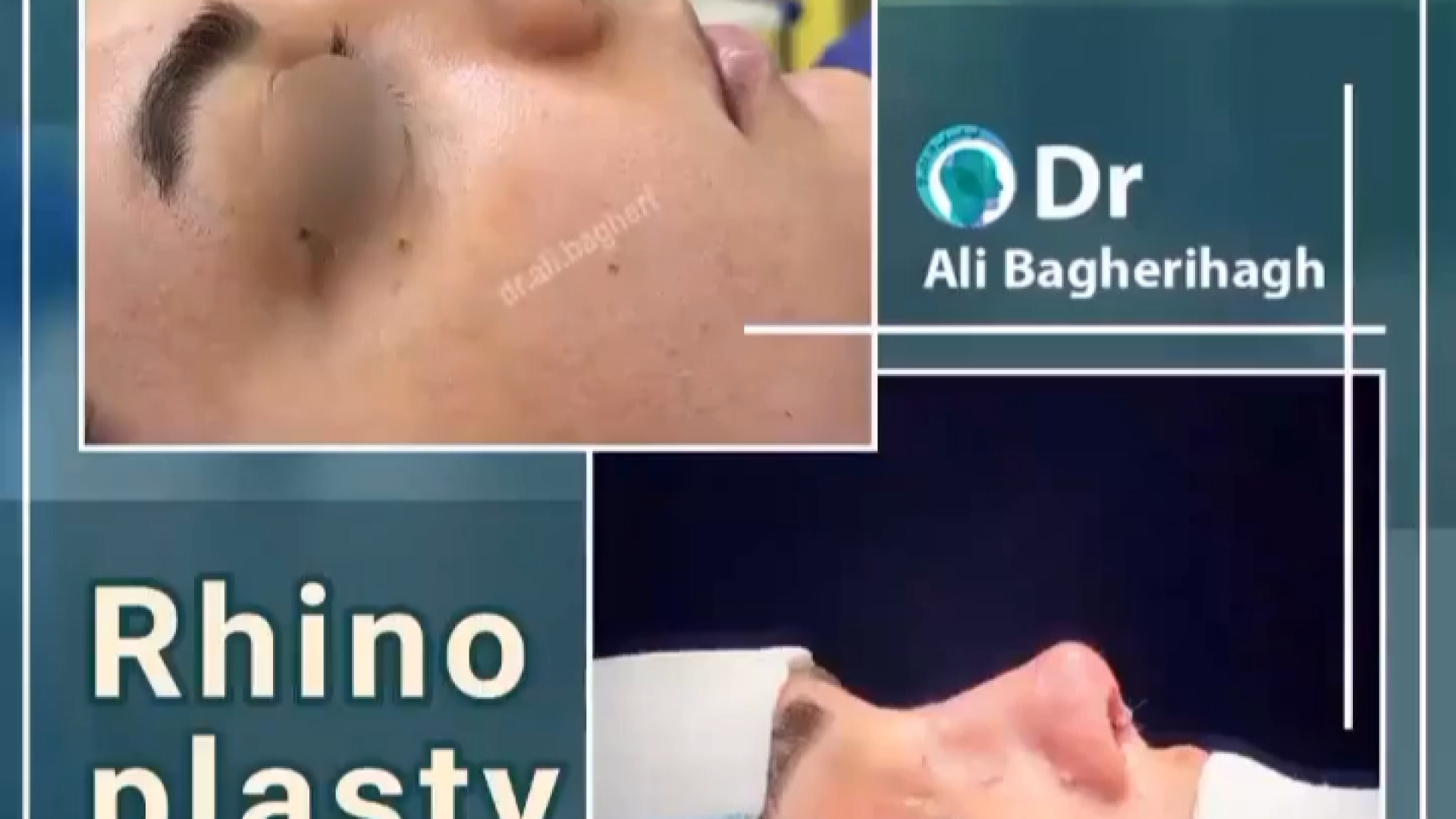 بلافاصله بعد از عمل بینی | دکتر باقری حق دکتر علی باقری حق