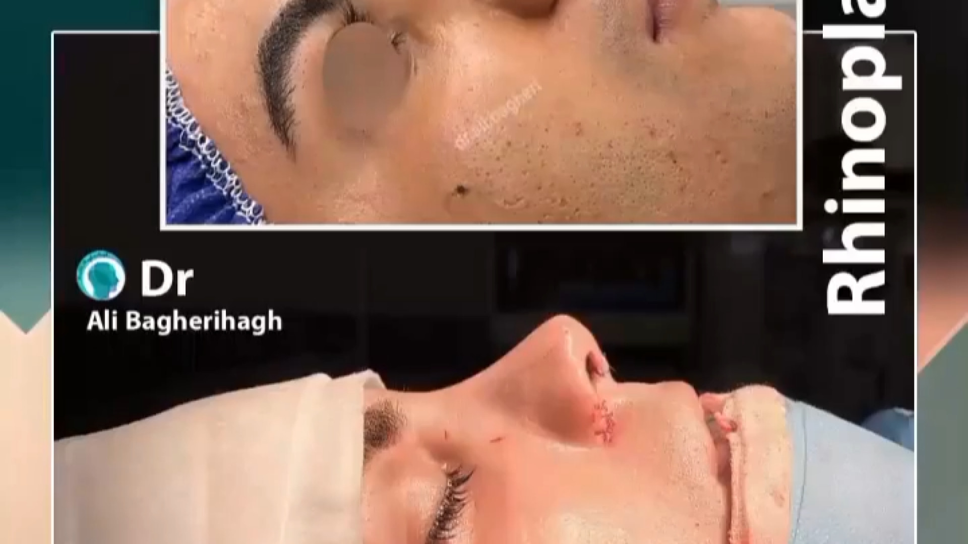 عمل بینی مردانه | دکتر باقری حق دکتر علی باقری حق