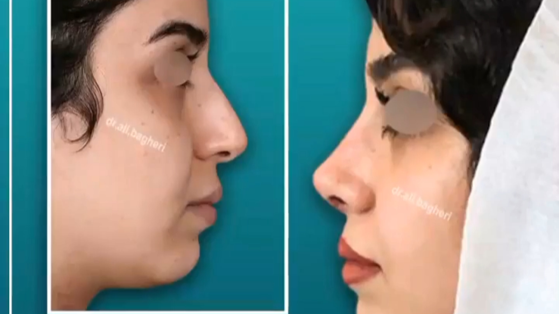 یک ماه بعد از عمل بینی با پوست ضخیم و دارای انحراف | دکتر باقری حق دکتر علی باقری حق