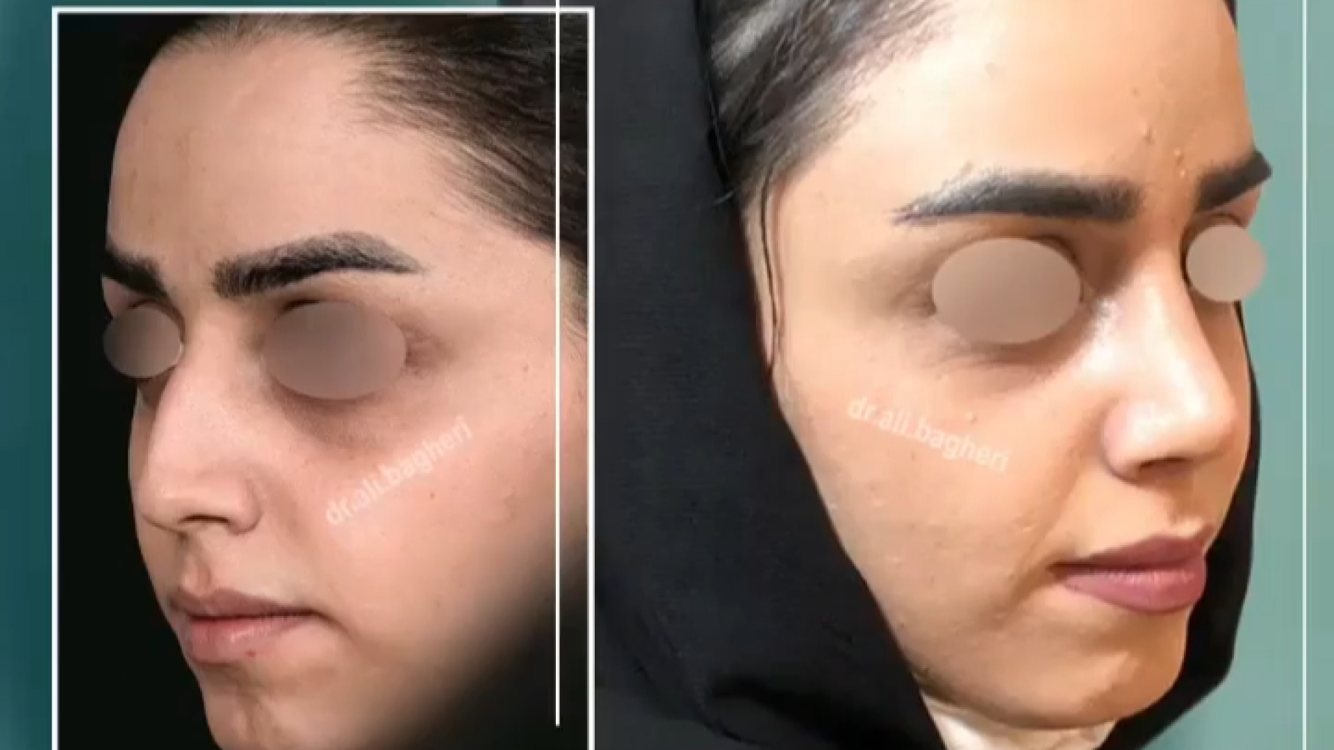 رفع قوز بینی | دکتر باقری حق دکتر علی باقری حق