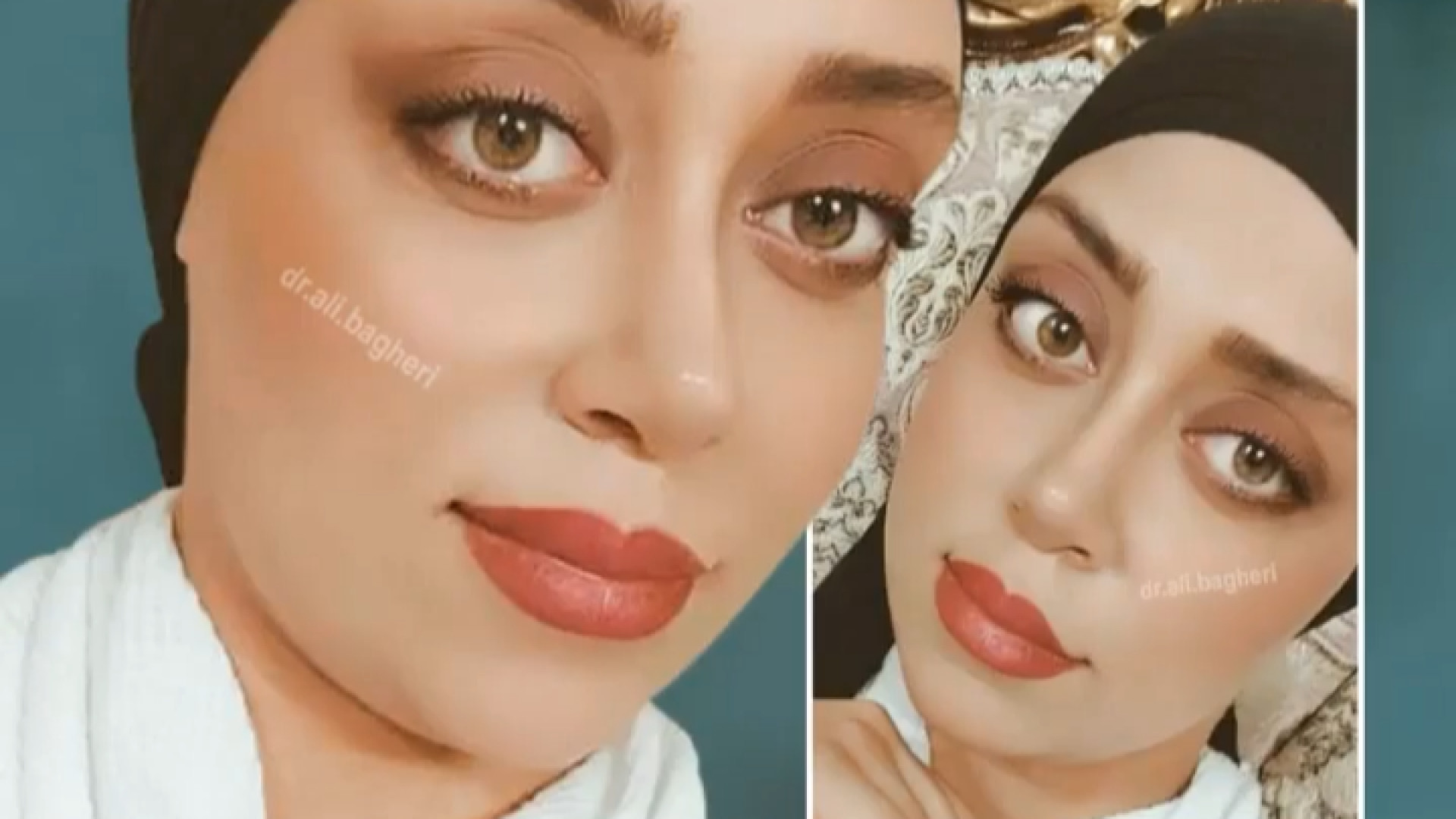 نمونه عمل بینی | دکتر باقری حق دکتر علی باقری حق