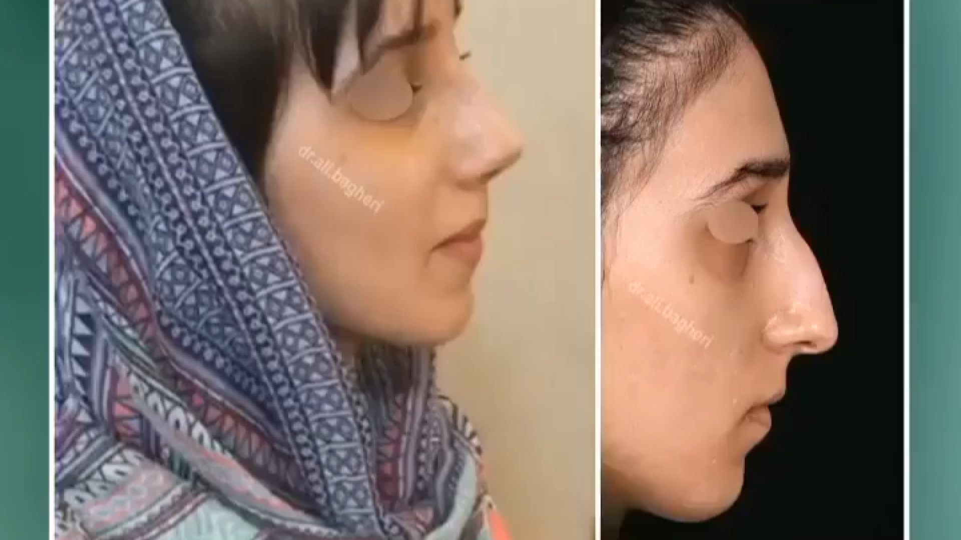 8 روز بعد از جراحی | دکتر باقری حق دکتر علی باقری حق