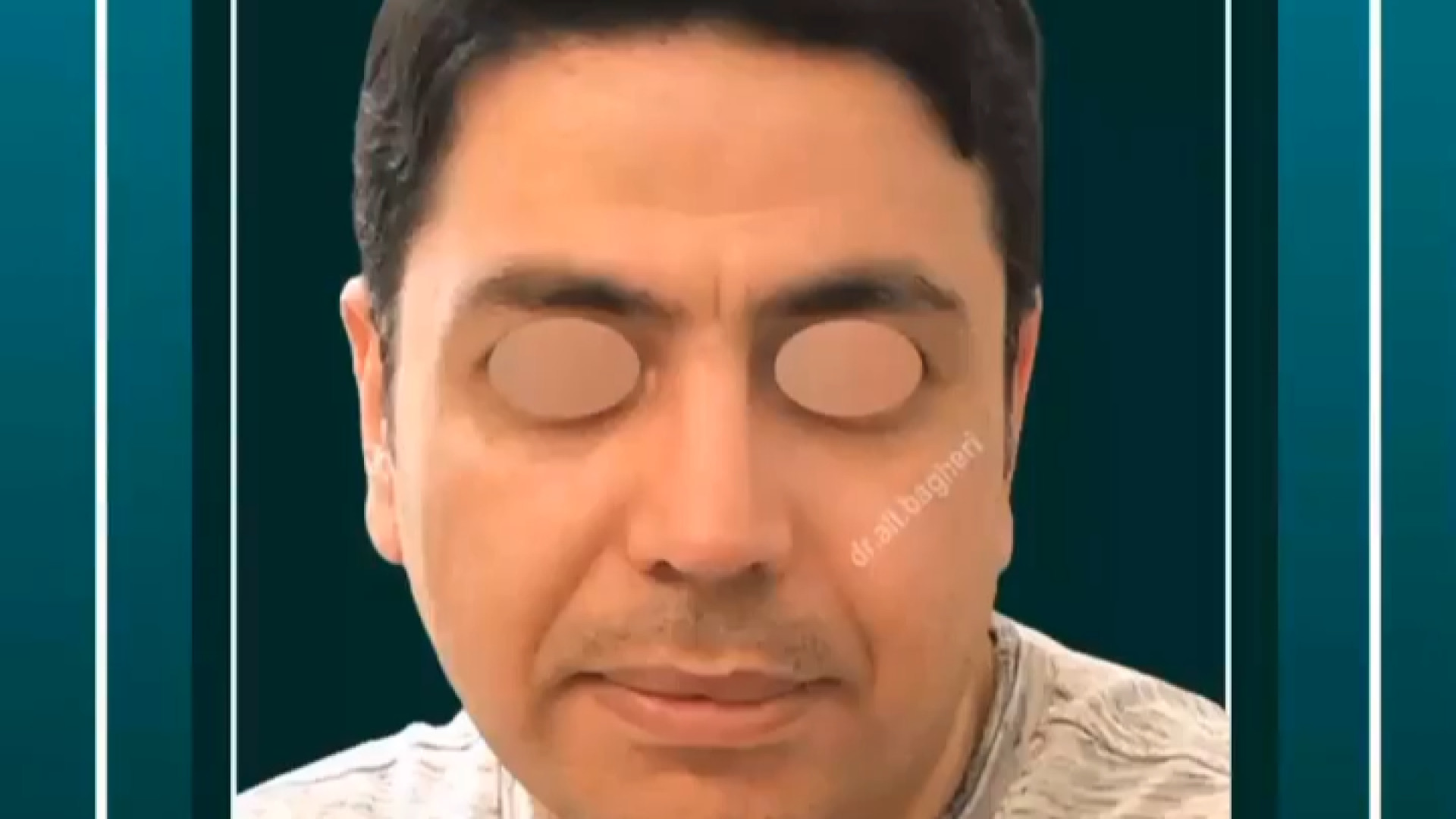 بینی حجیم دارای انحراف داخلی شدید دکتر علی باقری حق