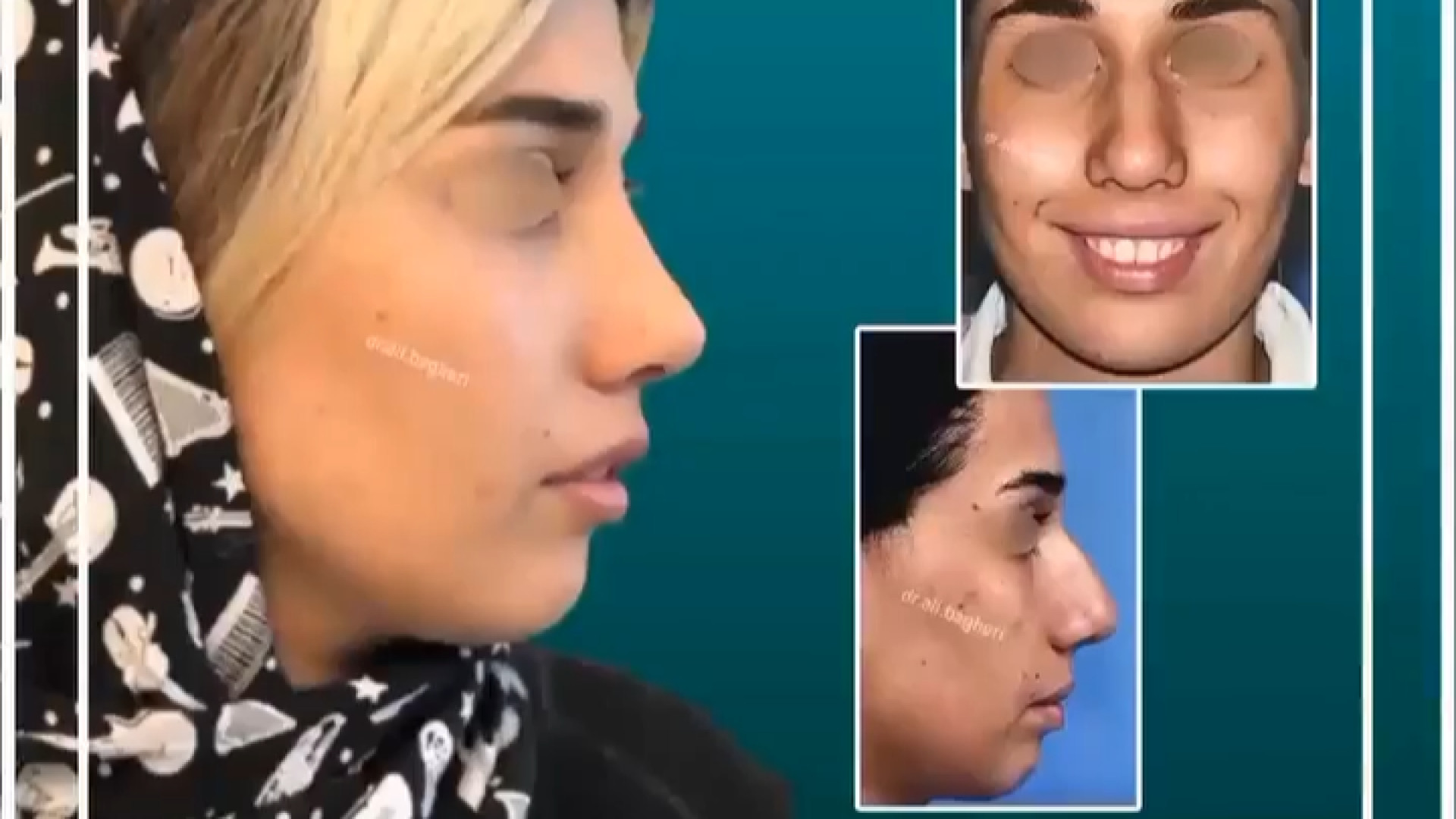 تغییر ، قبل و بعد از رینوپلاستی | دکتر باقری حق دکتر علی باقری حق