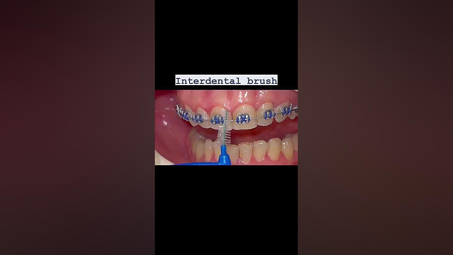 چطور با ارتودنسی مسواک بزنیم دکتر فرزاد ناصری متخصص ارتودنسی در اصفهان