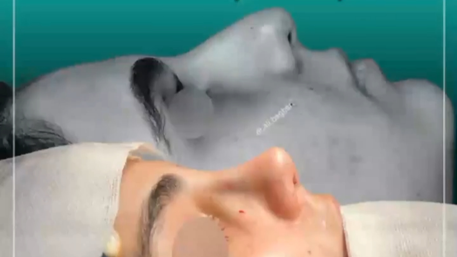 نمونه عمل بینی | دکتر باقری حق دکتر علی باقری حق