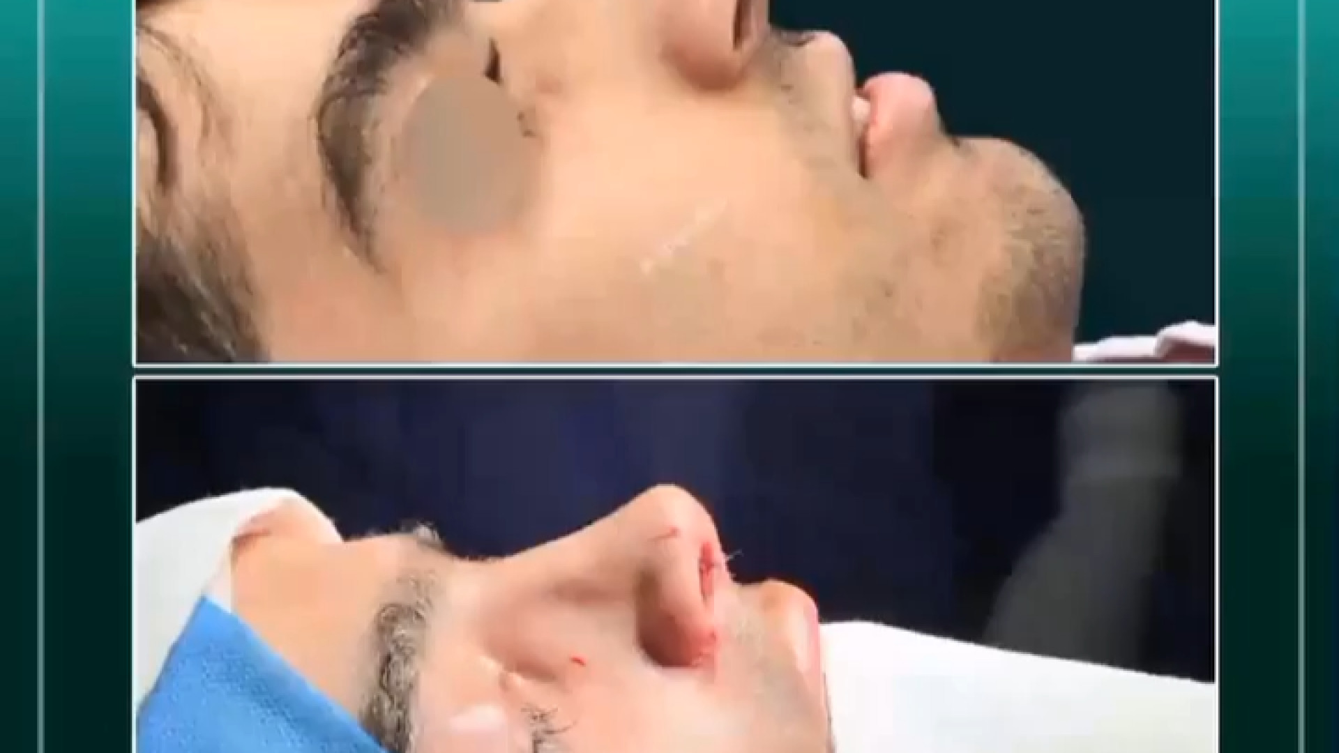 بینی قوزدار مردانه| دکتر باقری حق دکتر علی باقری حق