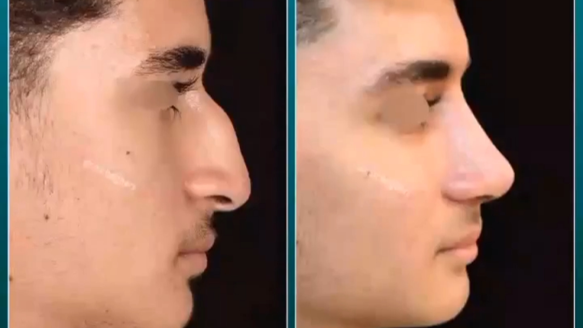 قبل و بعد از عمل بینی مردانه و طبیعی | دکتر باقری حق دکتر علی باقری حق