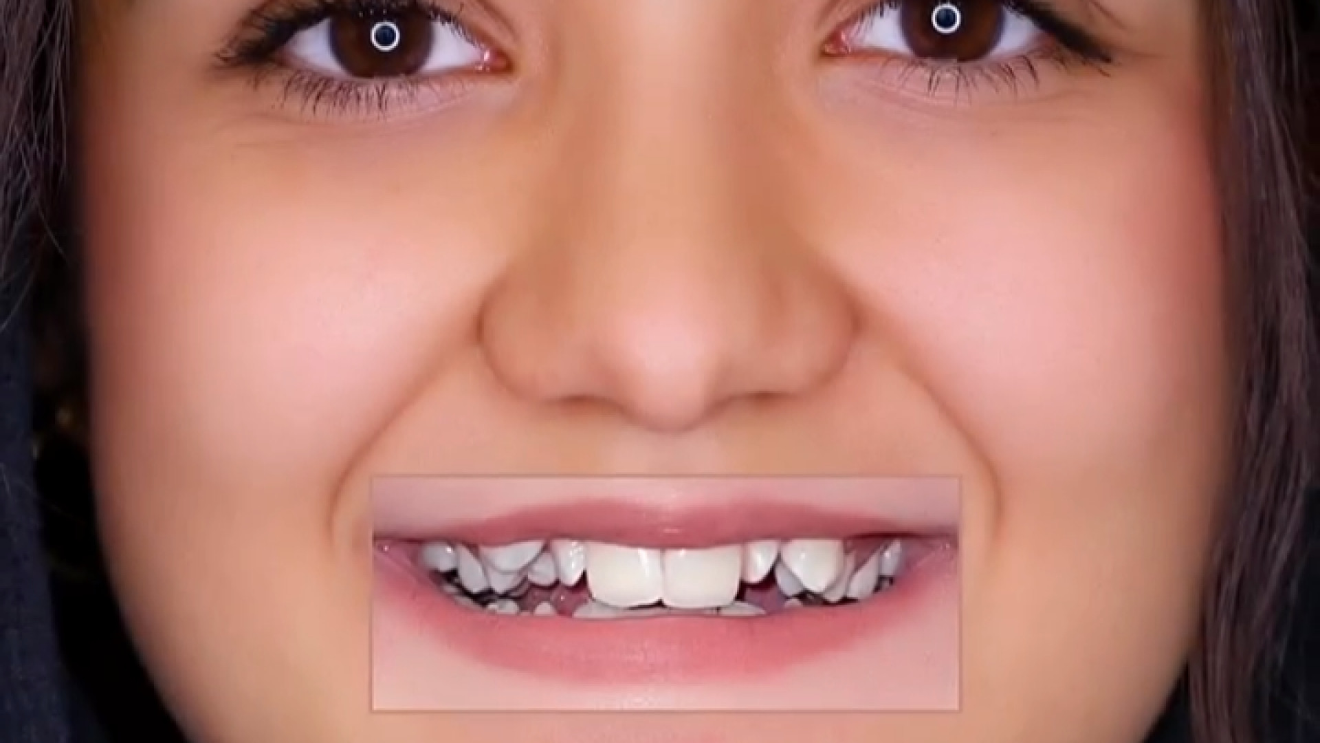 ارتودنسی ثابت بدون کشیدن دندان در مدت ۲ سال دکتر فرزاد ناصری متخصص ارتودنسی در اصفهان