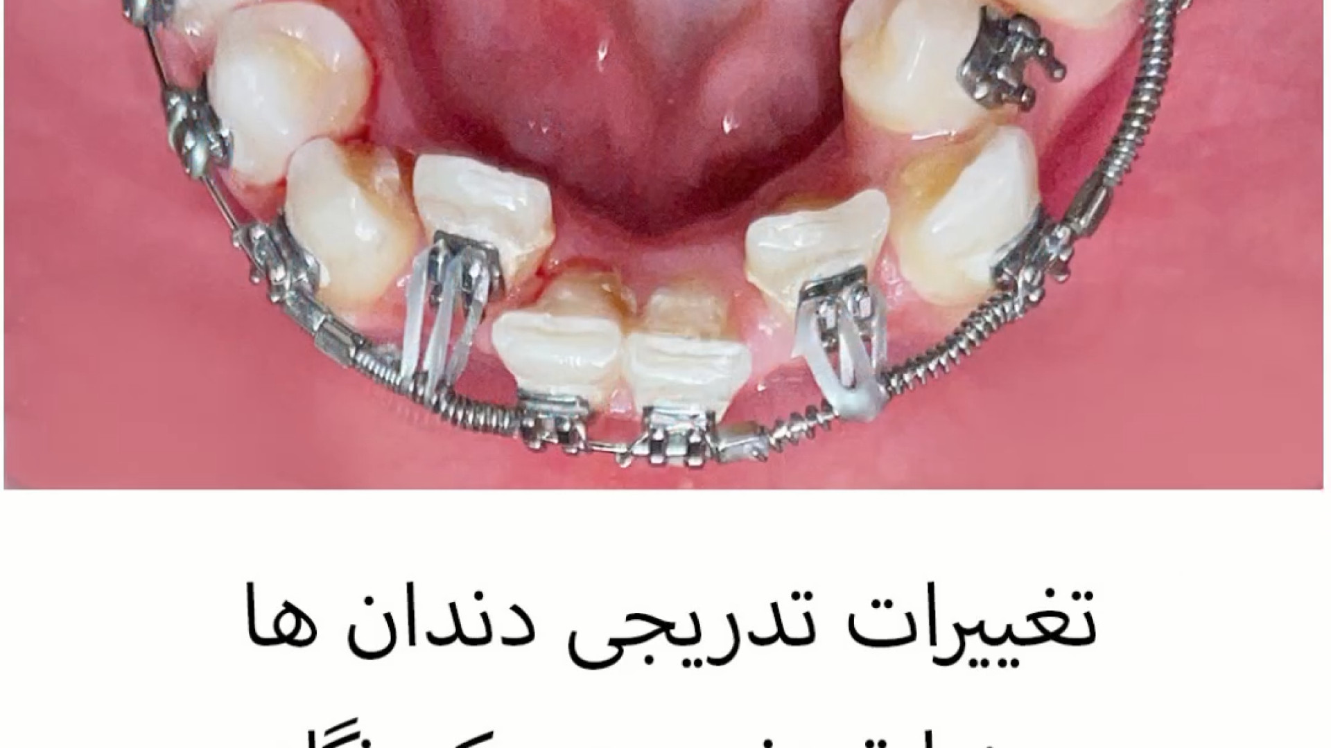 فیلم ارتودنسی دندان دکتر فرزاد ناصری متخصص ارتودنسی در اصفهان