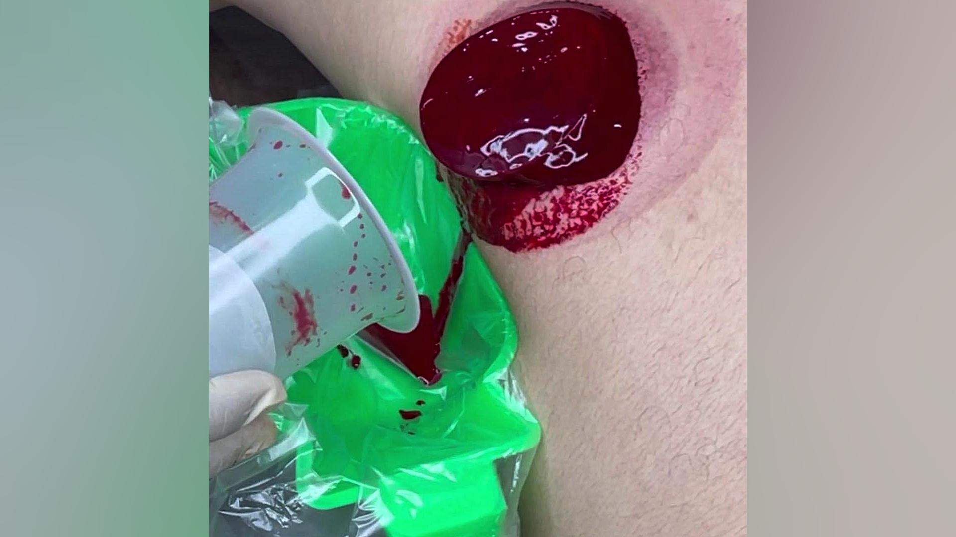 حجامت ریه اصلاح طرح لبخند