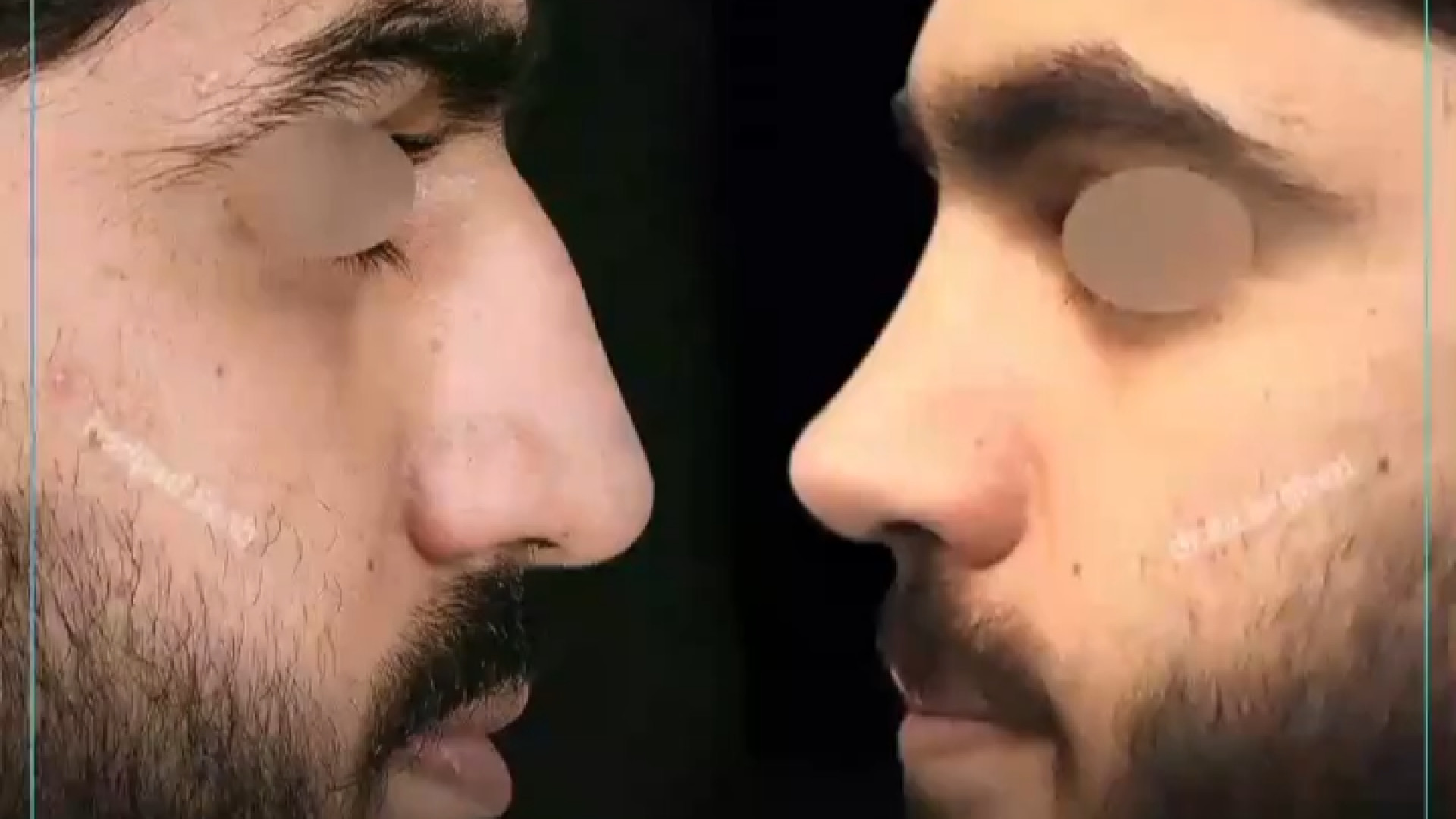 یکسال بعد از جراحی مردانه بینی گوشتی | دکتر باقری حق دکتر علی باقری حق