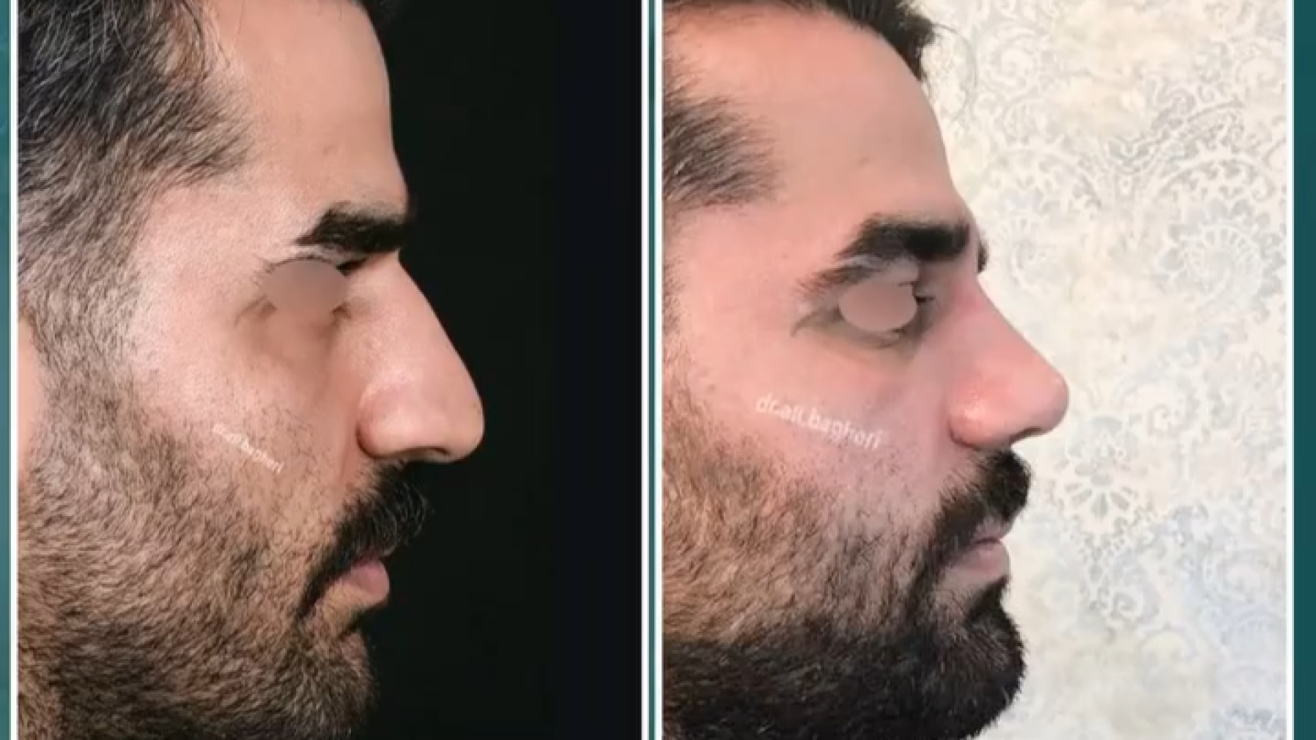 عمل بینی مردانه حجیم پس از دوماه | دکتر باقری حق دکتر علی باقری حق
