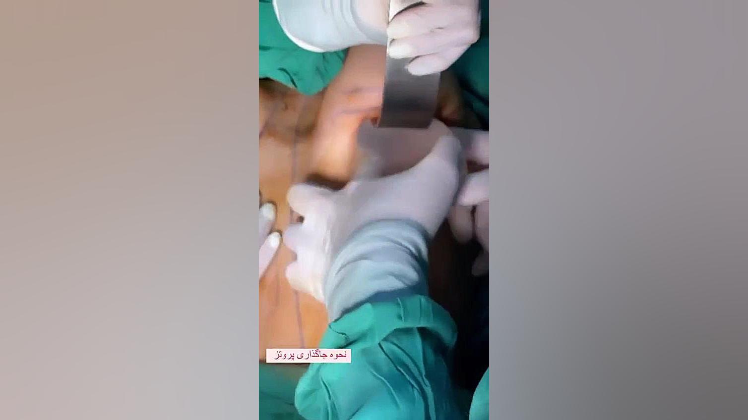نحوه جا گذاری پروتز سینه به صورت واقعی و در حین عمل مشهد بیوسنسور لاکتات خون