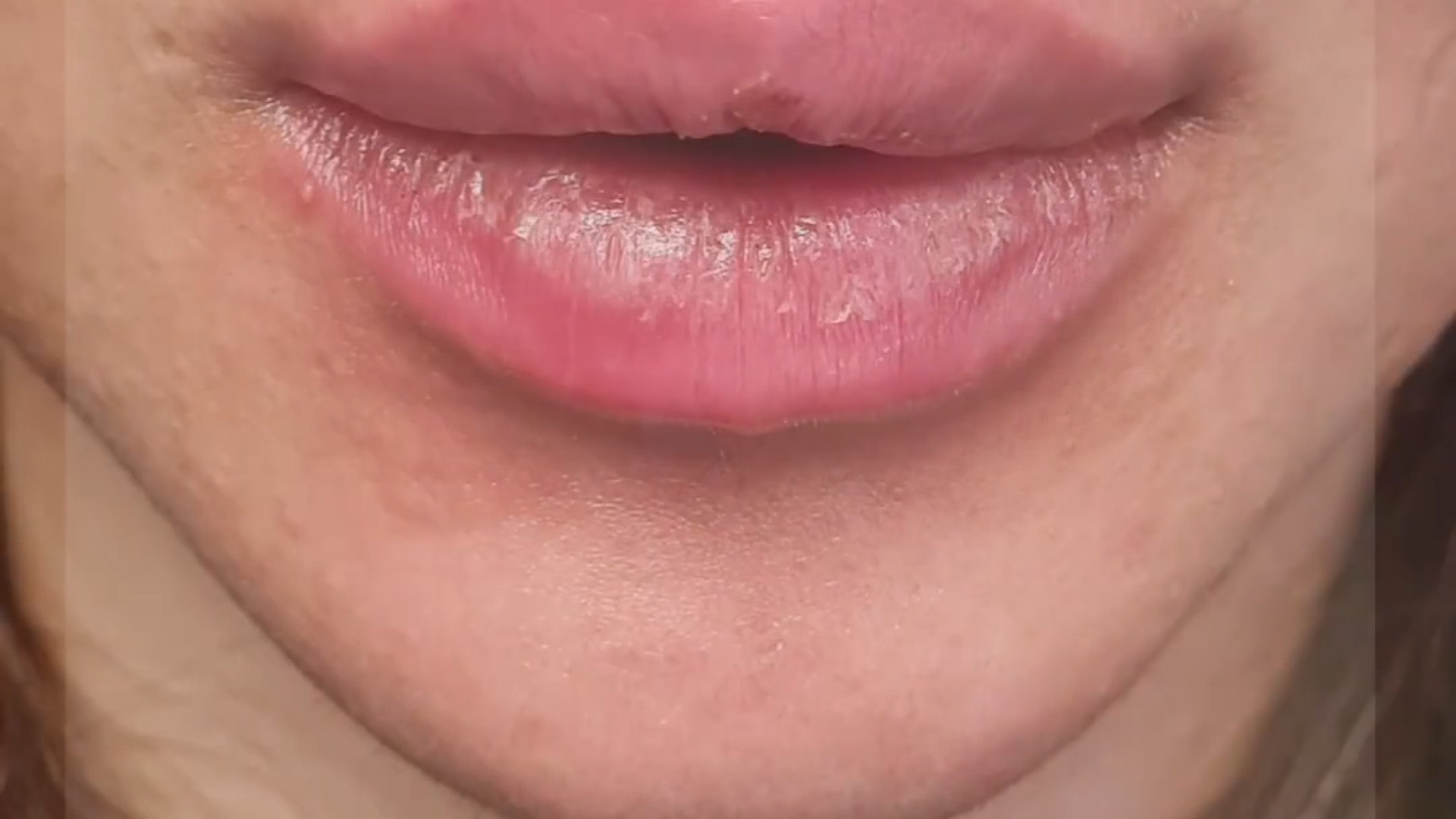 تزریق فیلر لب | دکتر مریم بیکی دکتر مریم بیکی - پوست و مو و زیبایی اراک