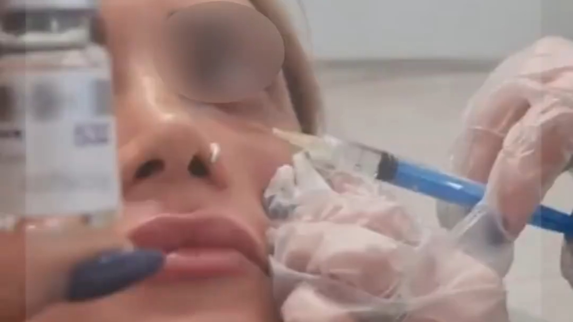 تزریق مزوژل روشن کننده زیر چشم | دکتر مریم بیکی دکتر مریم بیکی - پوست و مو و زیبایی اراک