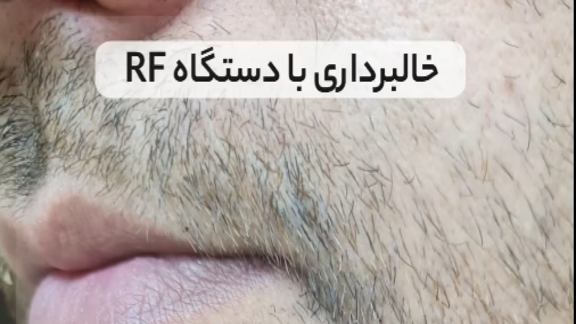 خالبرداری با دستگاه RF | دکتر مریم بیکی دکتر مریم بیکی - پوست و مو و زیبایی اراک