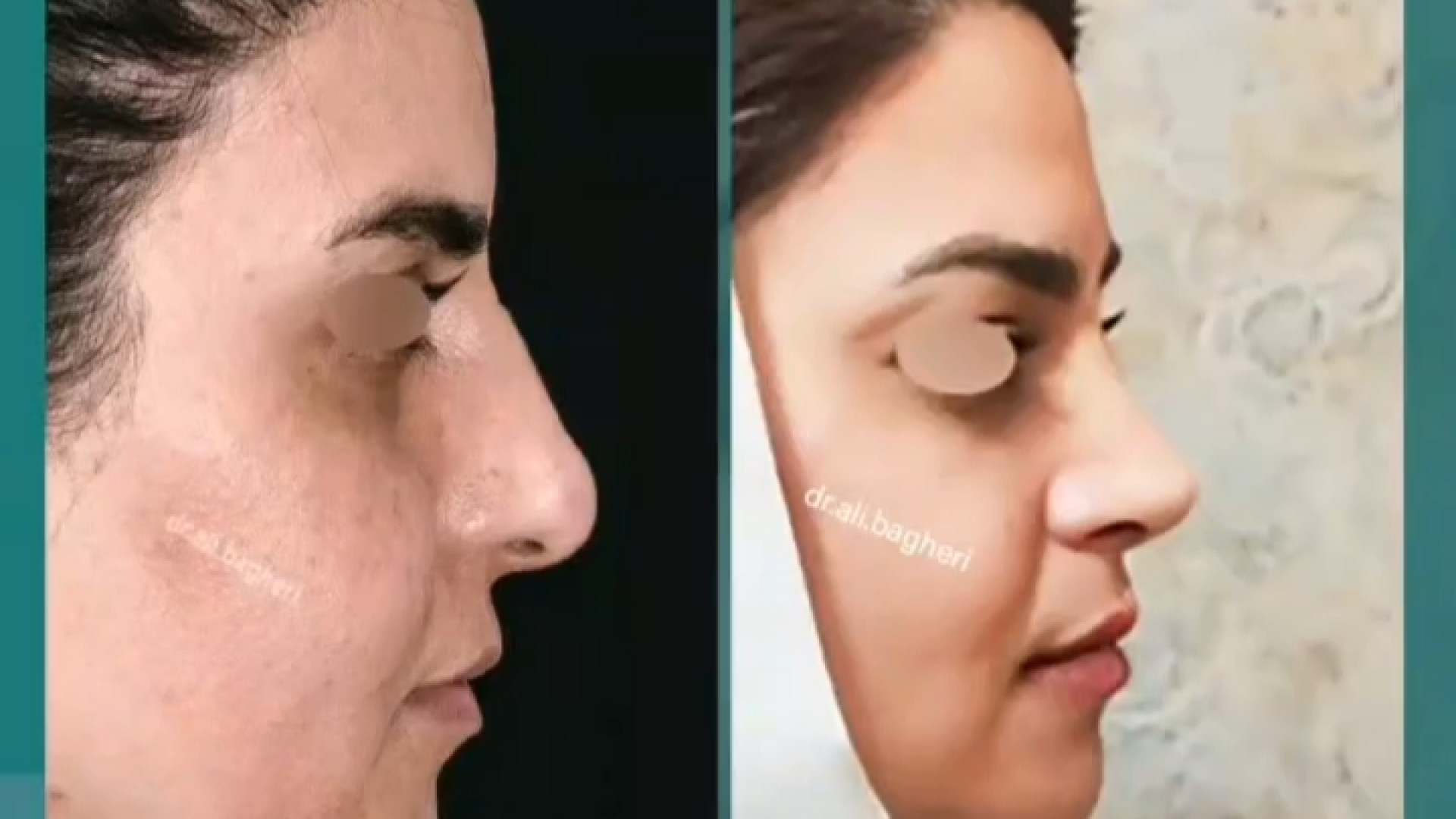 رینوپلاستی بینی نچرال | دکتر باقری حق دکتر علی باقری حق