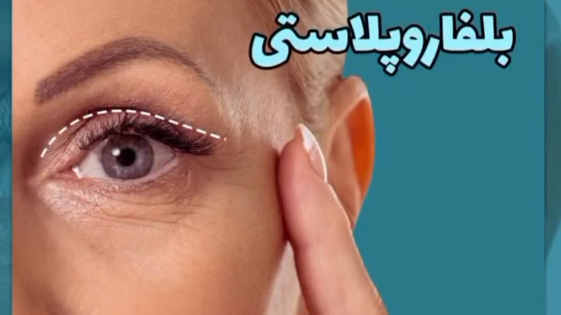 مزایای بلفاروپلاستی | دکتر باقری حق دکتر علی باقری حق
