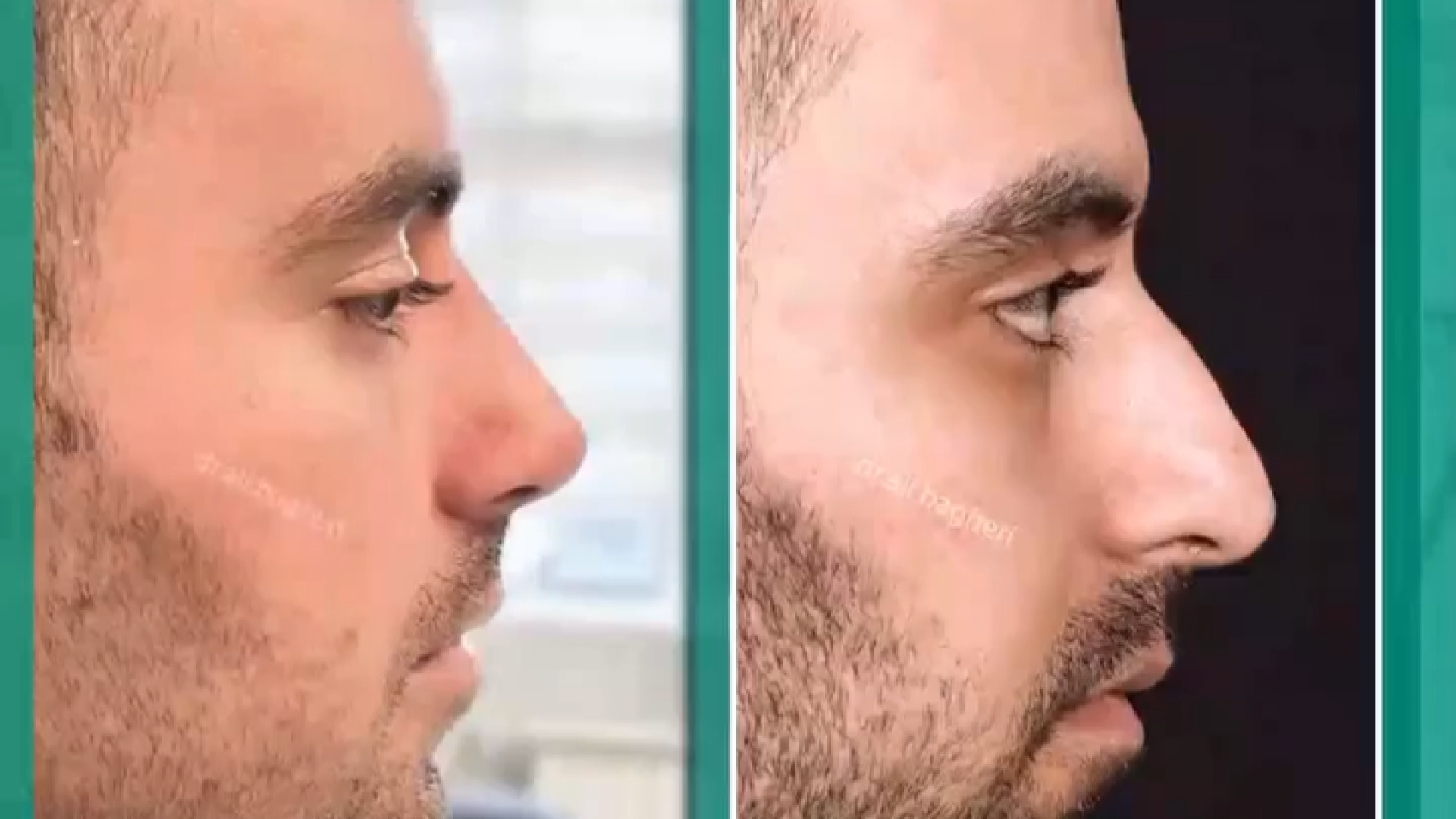 رینوپلاستی به صورت نچرال | دکتر باقری حق دکتر علی باقری حق