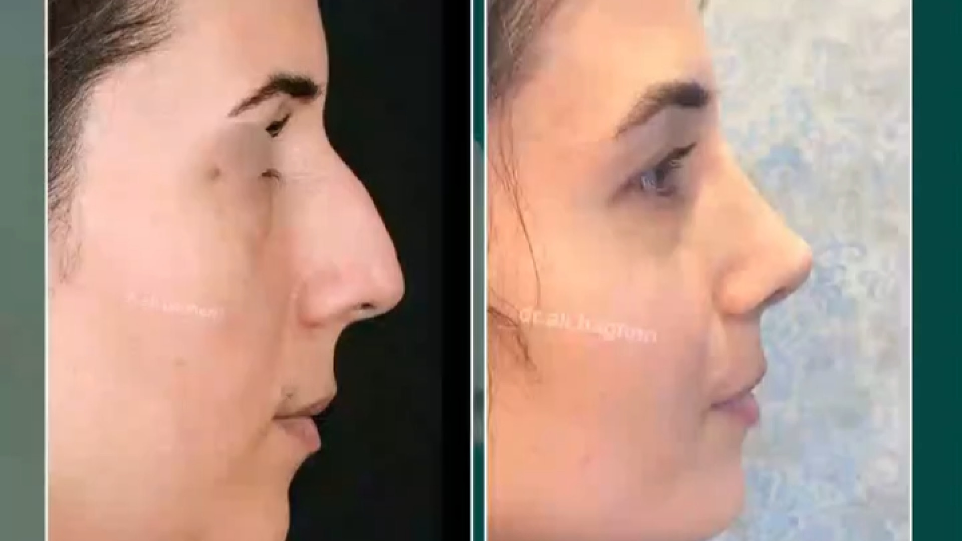 اصلاح قوز بینی | دکتر باقری حق دکتر علی باقری حق