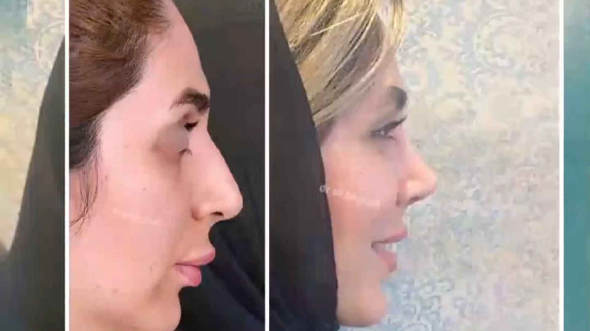 نتیجه عمل بینی | دکتر باقری حق دکتر علی باقری حق