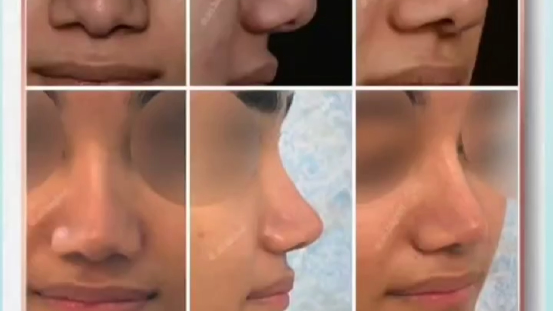 نمونه عمل های بینی | دکتر باقری حق دکتر علی باقری حق