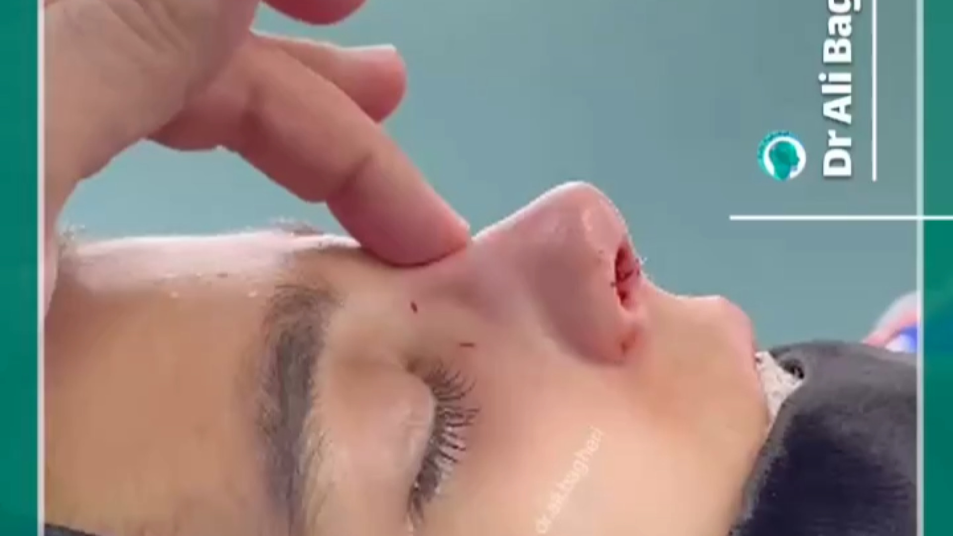 بلافاصله بعد از عمل بینی نیمه فانتزی | دکتر باقری حق دکتر علی باقری حق