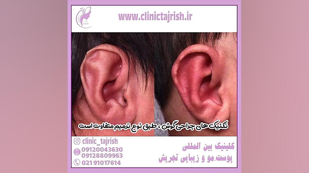 جراحی زیبایی گوش سیستم نانواینژکتور