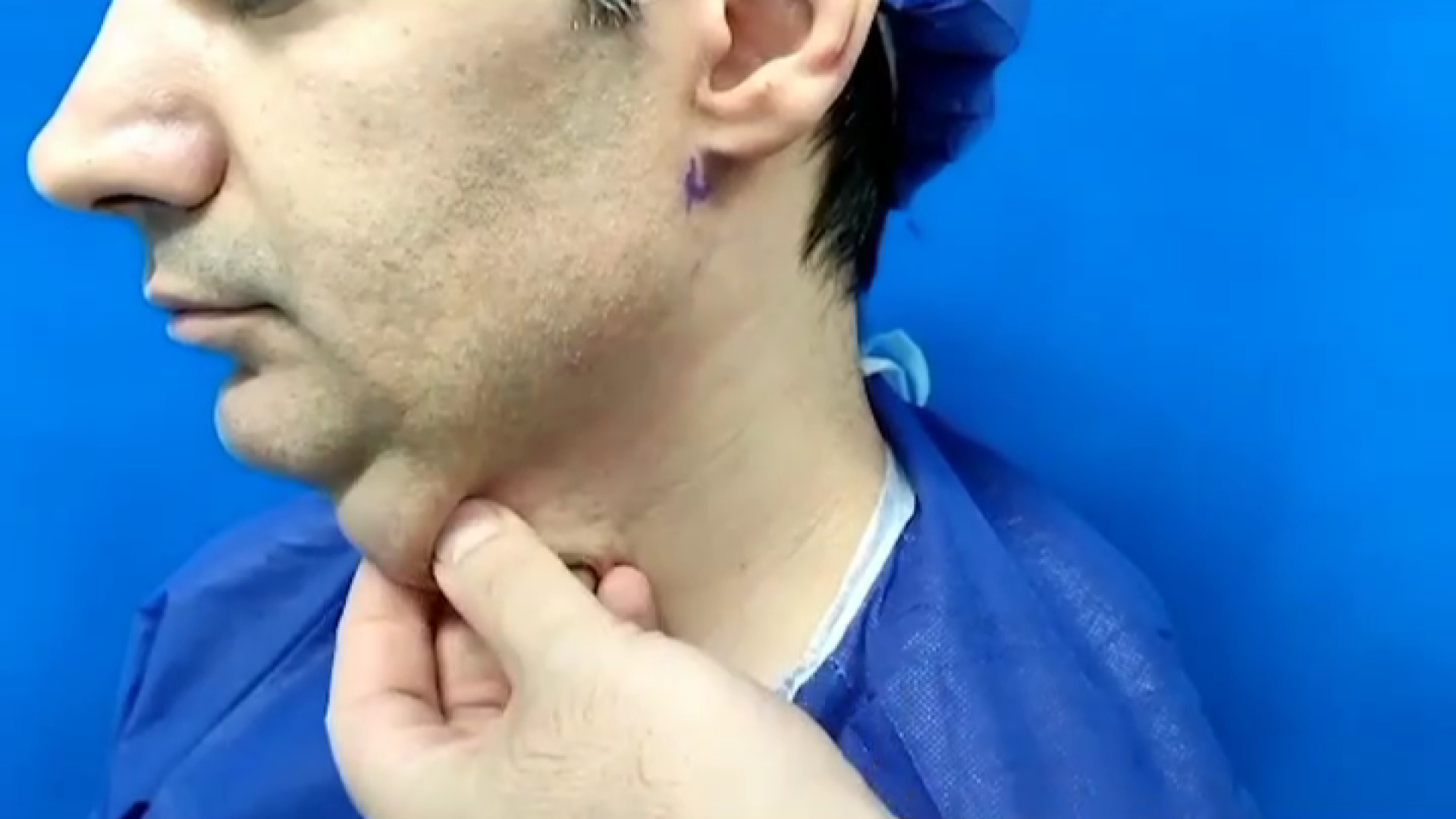 لیفت گردن بدون لیفت صورت دندانپزشک زیبایی