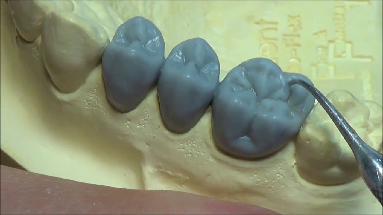 моляр верхний шестой моделировка зубов. моделирование коронки зуба. восковая моделировка wax up. вакс ап восковое моделирование. моделирование коронки зуба.