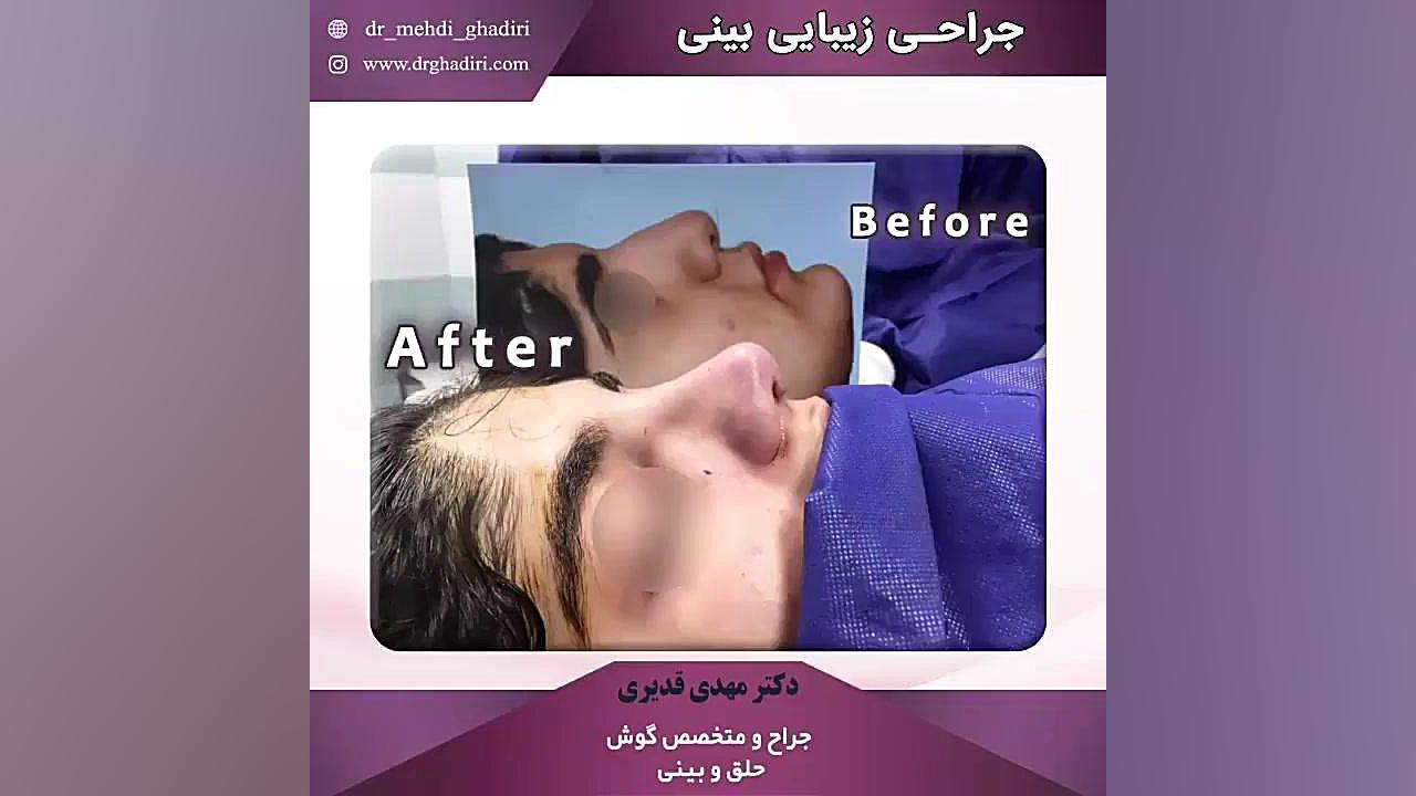 جراحی بینی دکتر مهدی قدیری