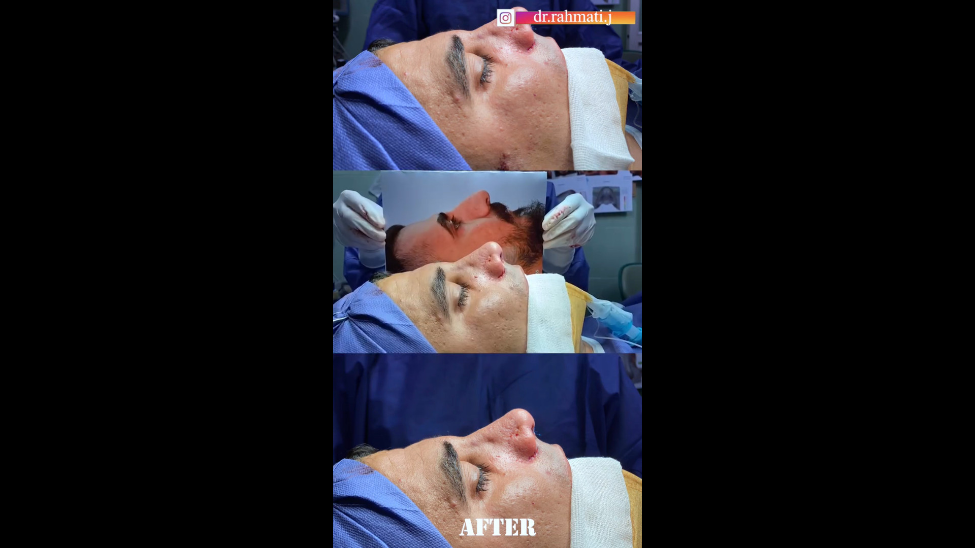 عمل بینی مردانه دکتر جواد رحمتی