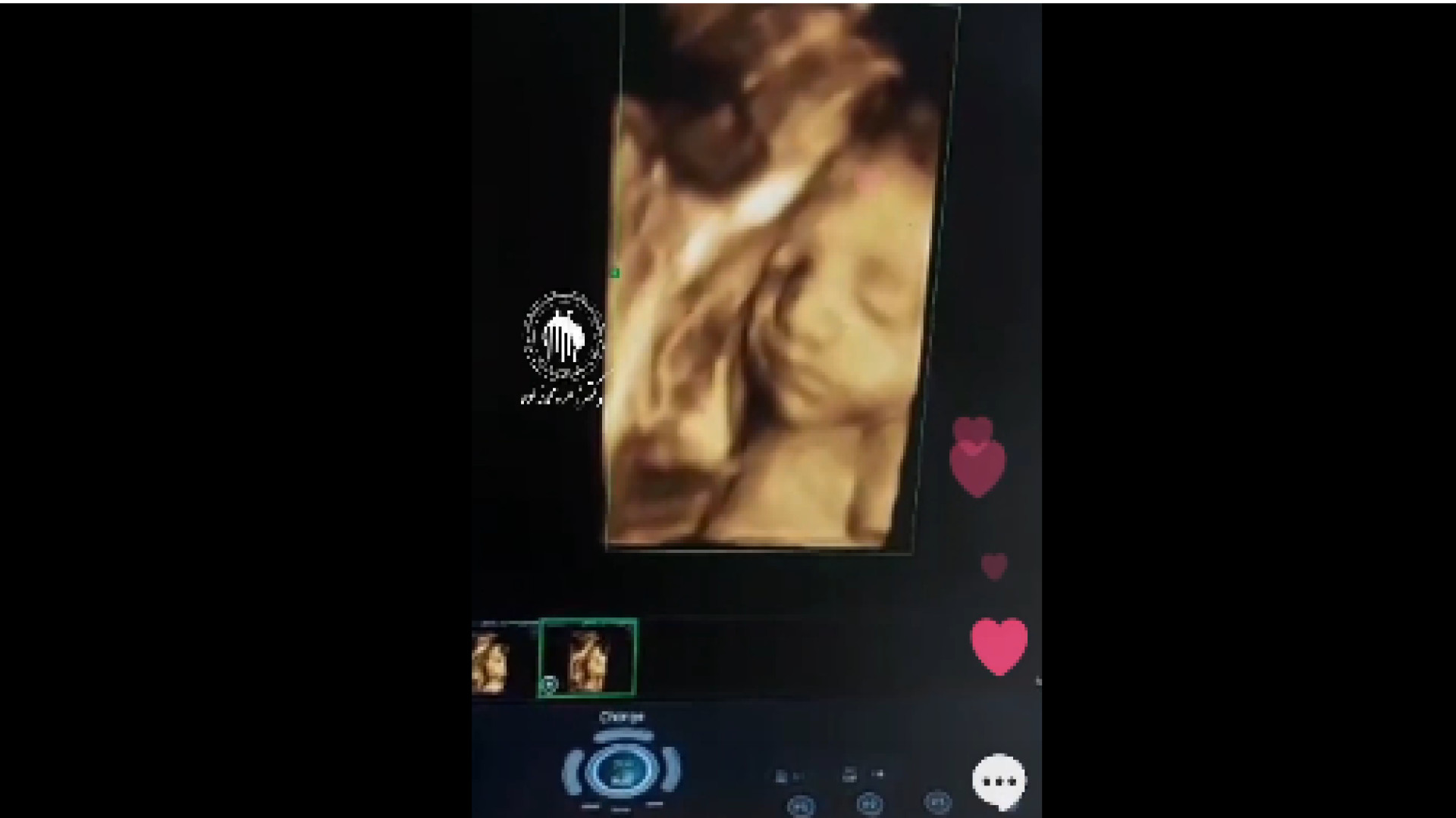 سونوگرافی صورت جنین قشنگمون3D هومن سیدی