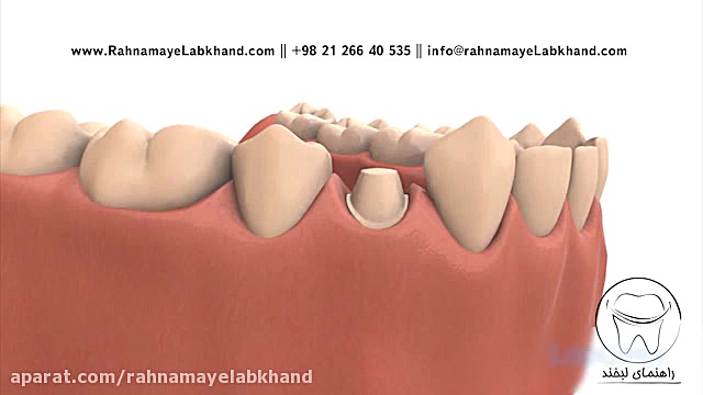 روکش دندان ایمونولوژی محاسباتی