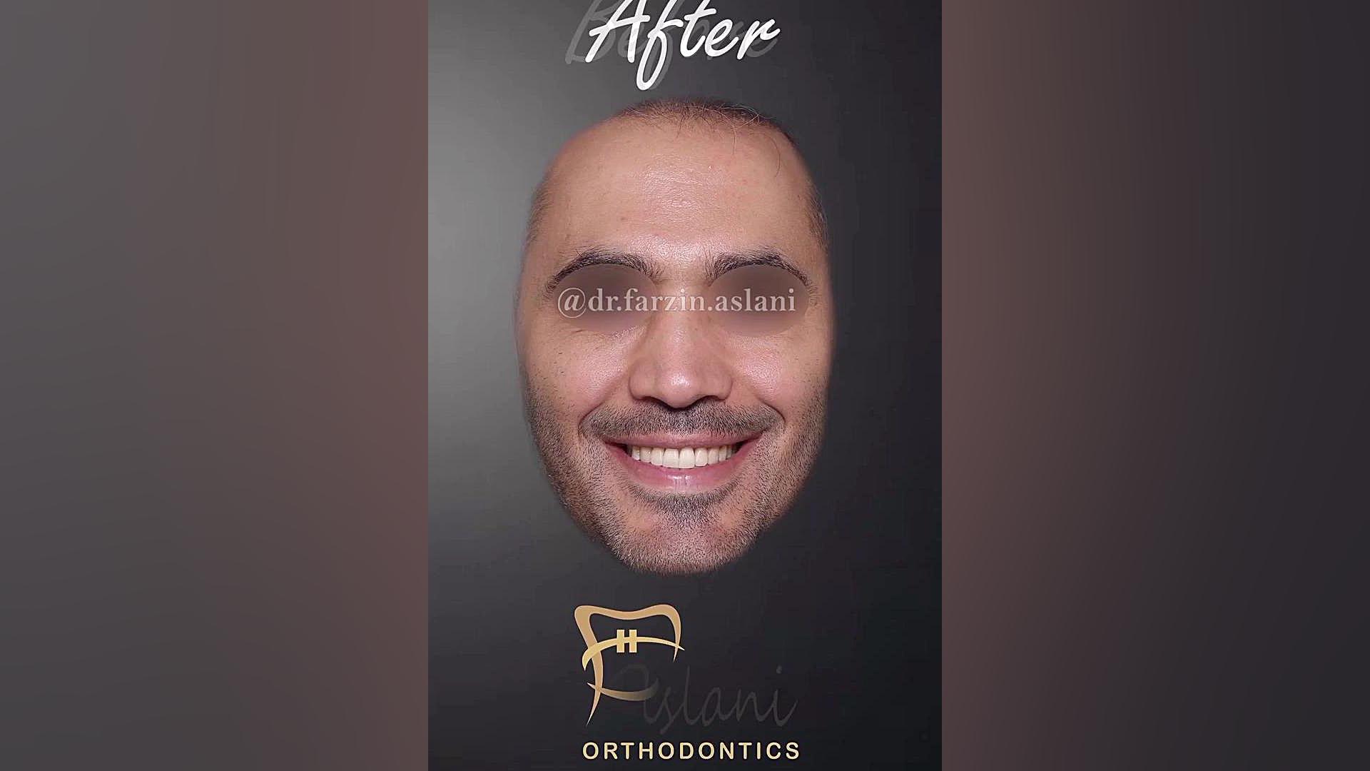 ارتودنسی و جراحی فک در تهران (ارتوسرجری) HiChIP