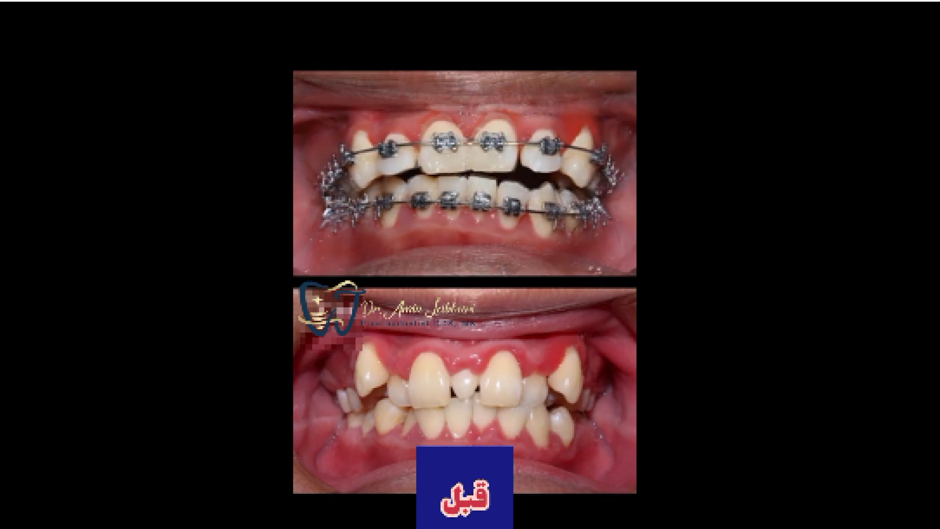 نتیجه ارتودنسی دکتر امین جباری