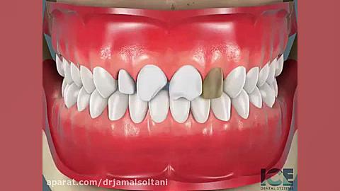 لمینت سرامیکی دکتر جمال سلطانی دندانپزشک خوب در تبریز