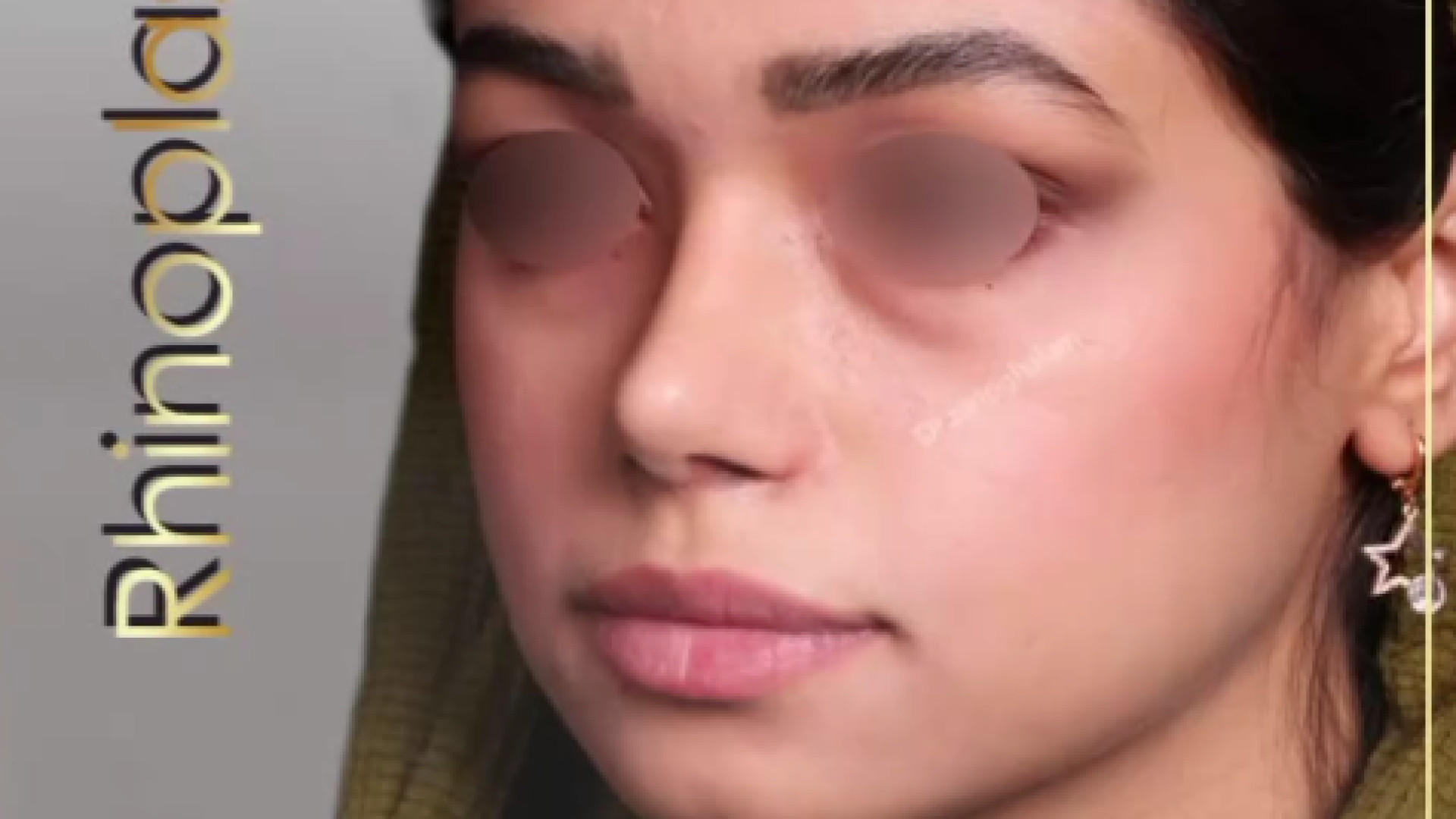 عمل بینی نیمه فانتزی توسط دکتر محمدعلی زرین قلم