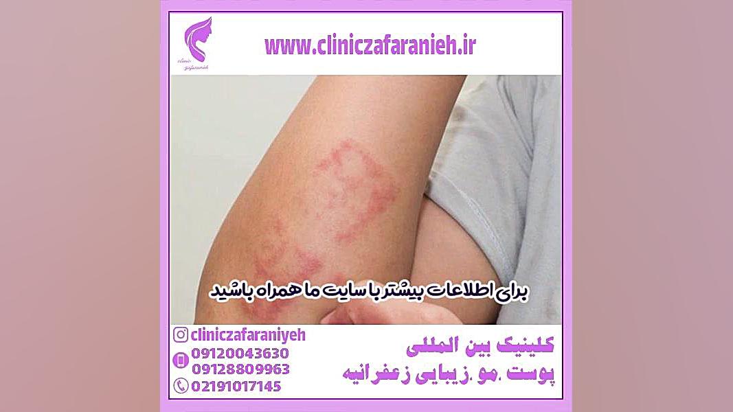 بهترین پماد برای درمان پسوریازیس سلفی