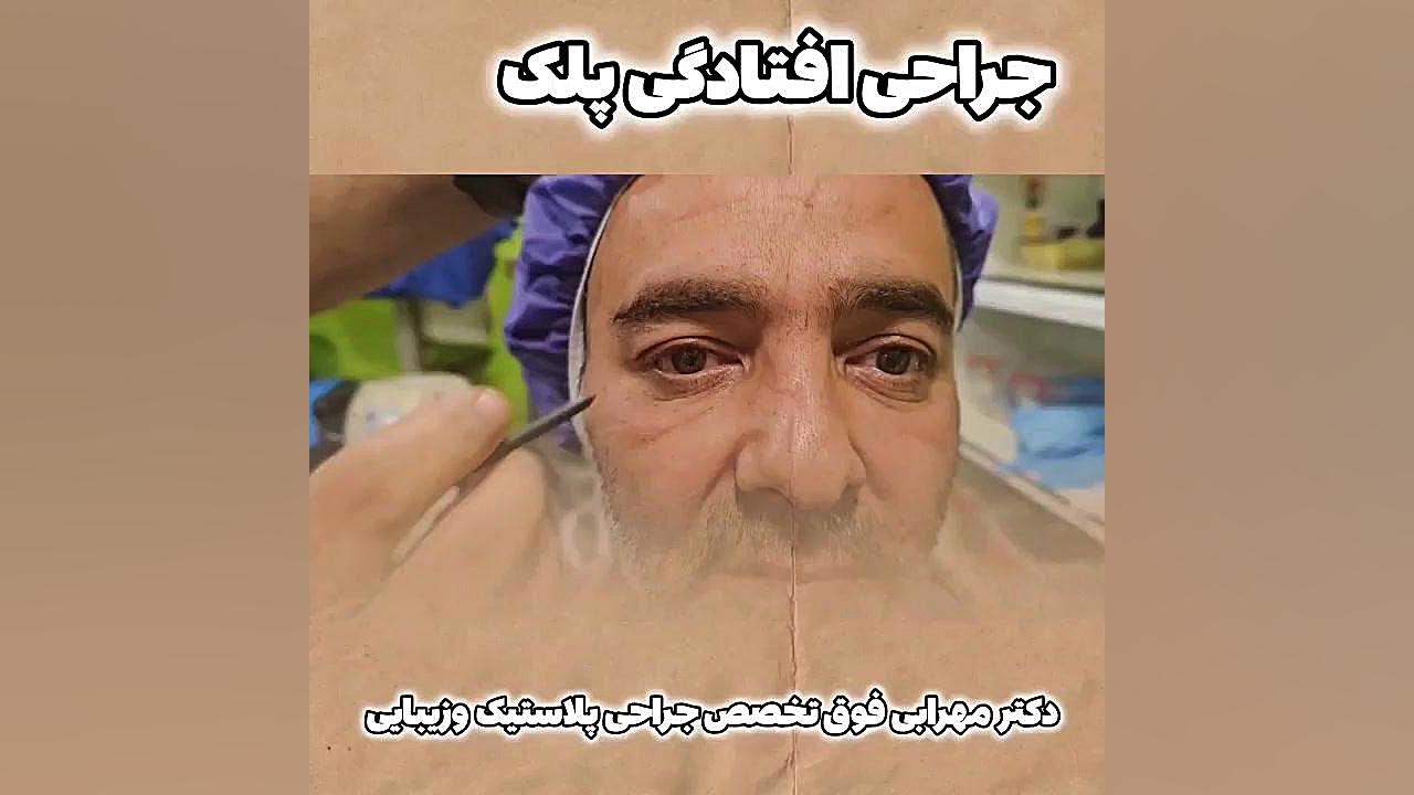 فیلم عمل افتادگی پلک در شیراز دکترمحمدمهدی مهرابی دکتر محمد مهدی مهرابی جراح پلاستیک و زیبایی