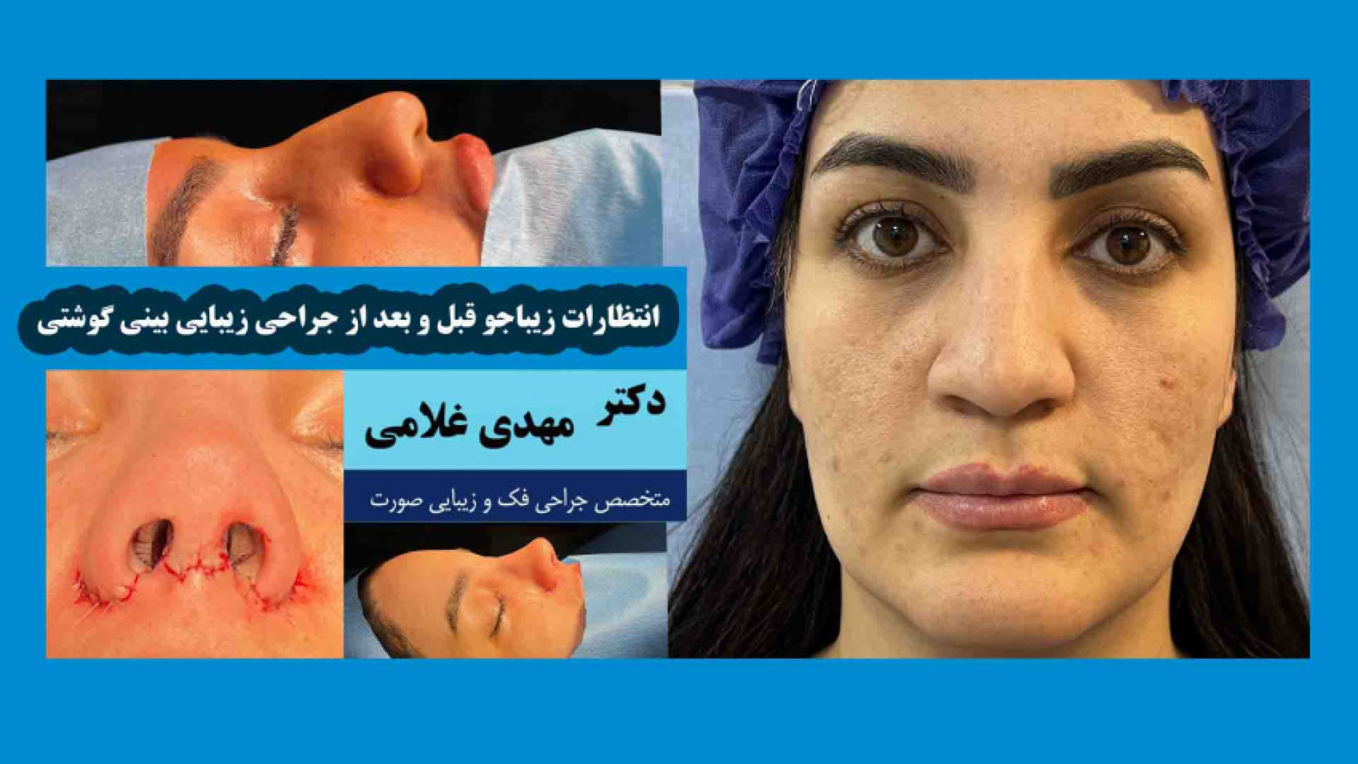 انتظارات زیباجو قبل و بعد از جراحی زیبایی بینی گوشتی دکتر مهدی غلامی