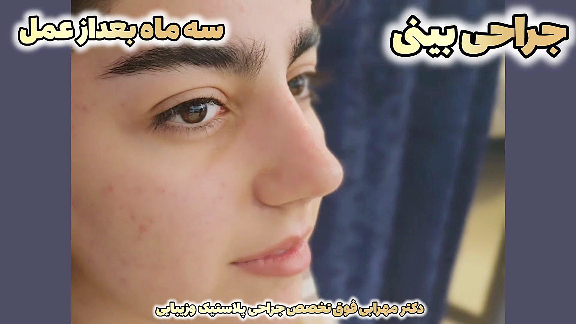 عمل بینی گوشتی در شیراز دکتر محمد مهدی مهرابی فوق تخصص جراحی پلاستیک وزیبایی دکتر محمد مهدی مهرابی جراح پلاستیک و زیبایی