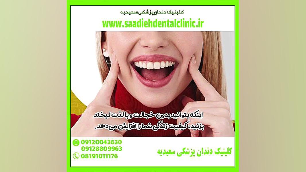 روکش دندان pfm چیست دندان مصنوعی