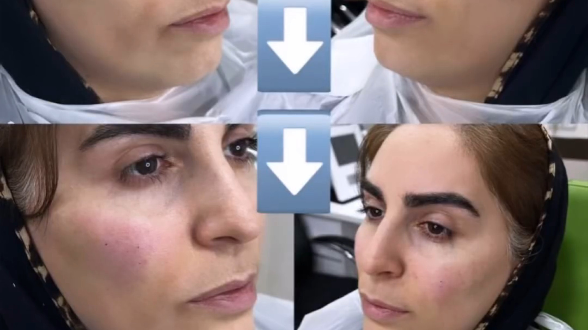 تزریق فیلر چانه و گونه | دکتر میعاد مهدوی | دکتر پوست و مو هیدروپس فتالیس