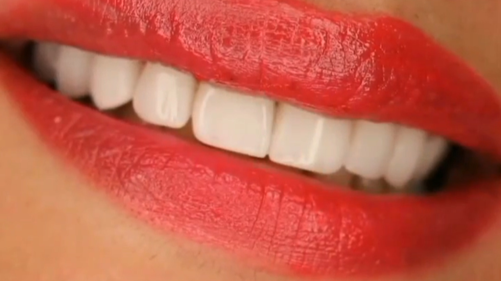 نمونه کار دکتر ندا هادی دکتر ندا هادی-دندانپزشک زیبایی