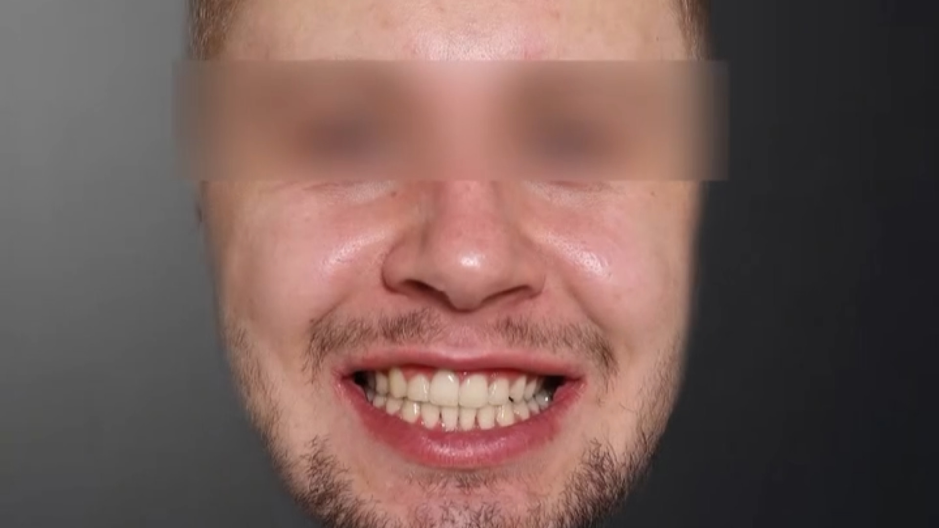 درمان ارتودنسی و جراحی فک(ارتوسرجری)دو مرحله ای… سینتولاژوماب