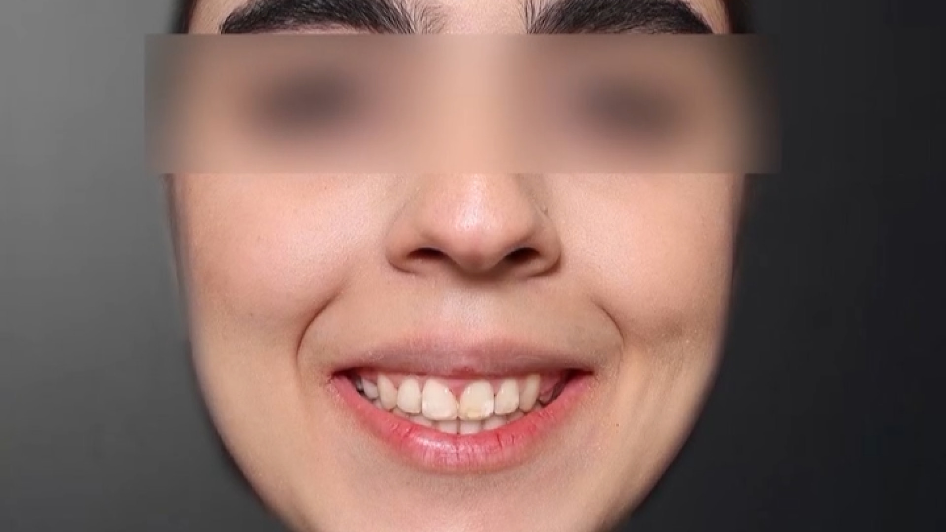 درمان ارتودنسی بدون جراحی فک برای عریض نمودن فک بالا و مرتب کردن دندان ها… کربتوزوماب