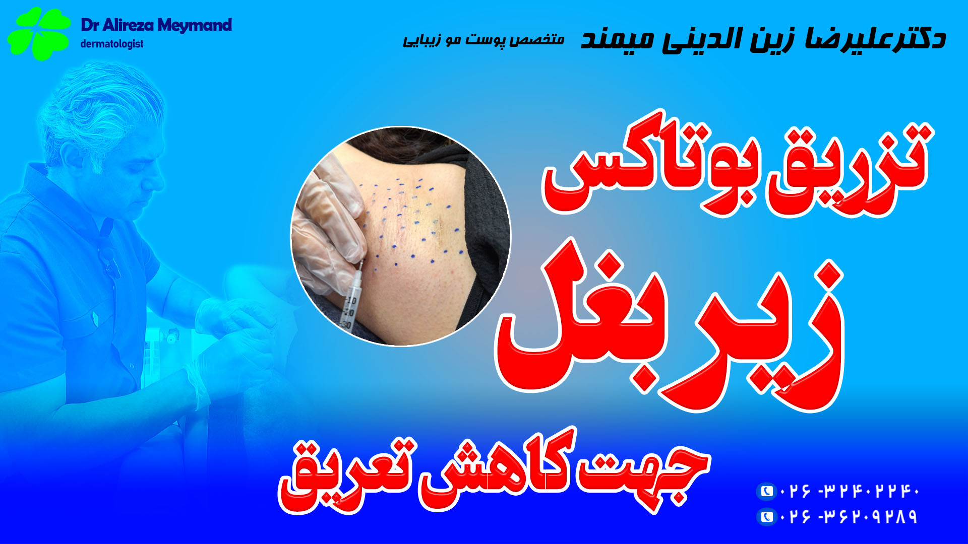 درمان عرق کردن زیر بغل با بوتاکس دکتر میمند متخصص پوست کرج تزریق بوتاکس ژل چربی کلینیک مو